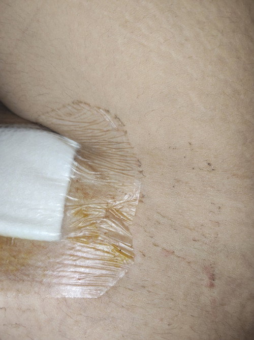 แบบนี้ ถ้าอาบน้ำ น้ำจะเข้ามั้ยค่ะ แผลผ่าคลอด