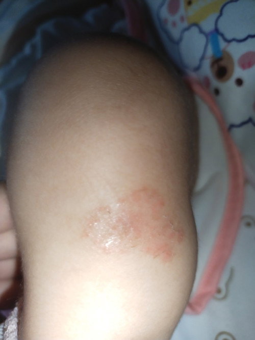 kaki anak seperti koreng