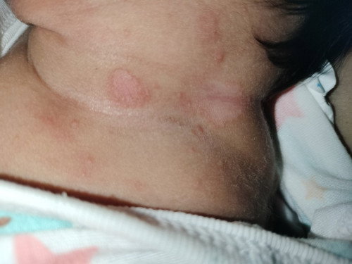 ผดผื่นหรือว่าเกลื้อนน้ำนม?