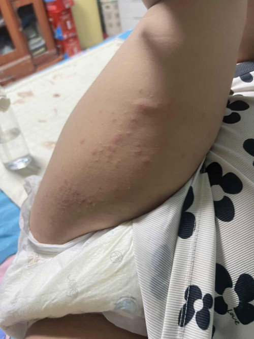สอบถามค่ะ มีลูกใครเคยผดผื่นขึ้นแบบนี้ไหมคะ