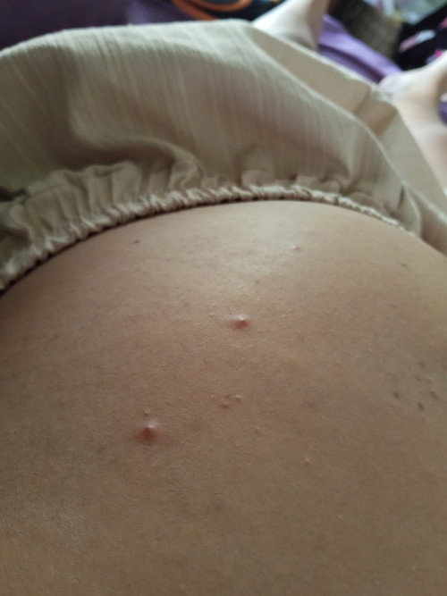 มีแม่คนไหนก็ตุ่มคันขึ้นที่ท้องไหมคะ