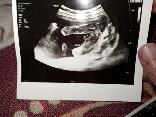 Mommy help conferm kan ggirl btw ni perbezaan 20w dan gambar ke 2 , 22w