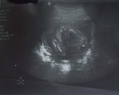 แม่ๆช่วยกันดูหน่อยค่ะใช่ผู้ชายมั้ยคะอันนี้ตั้งแต่20สัปดาห์ตตอนนี้34+4แล้วค่ะ😍