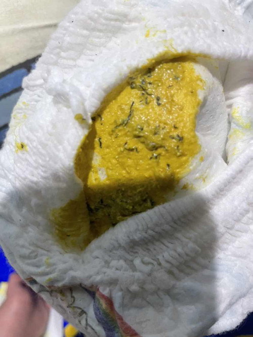 อุจาระมีเส้นสีดำ