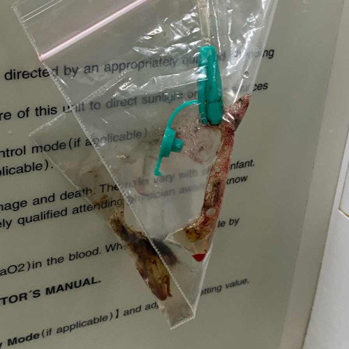 Bayi prematur muntah coklat