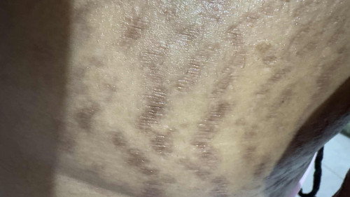 Strechmark after lahiran