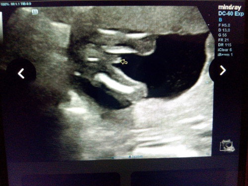 Boleh check tak gender baby saya ni. Dah 17 week plus tapi tak dapat kenal pasti.