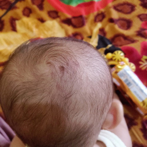 Biang keringat di kepala bayi