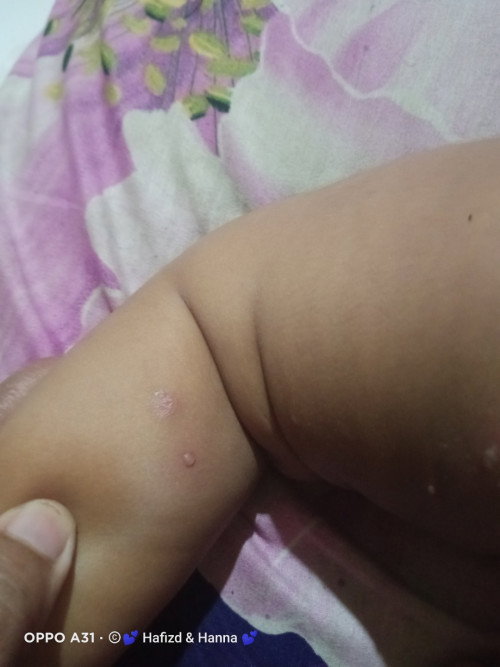 Cacar air apa bukan ?