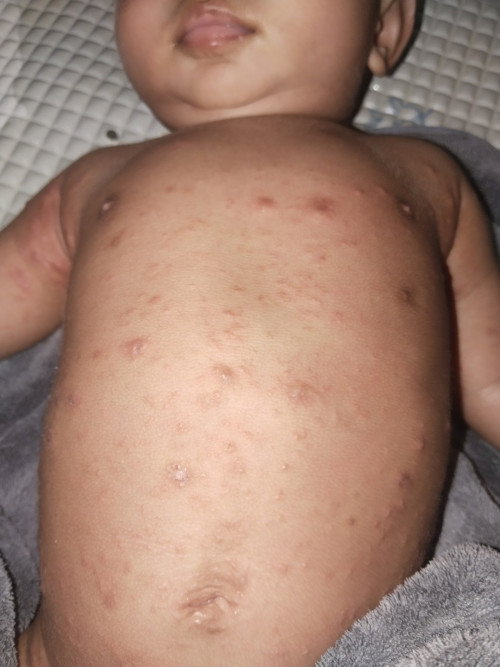 Bun minta saran salep yg bagus