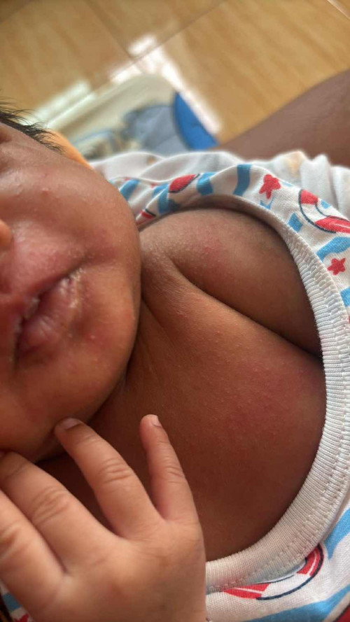 ผดร้อนหรือแพ้คะแม่ๆ