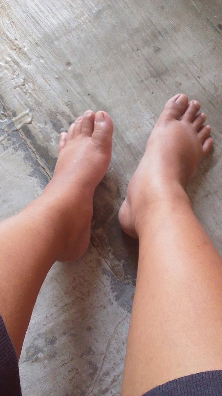 Kaki mcm terasa bengkak usia 
35minggu.