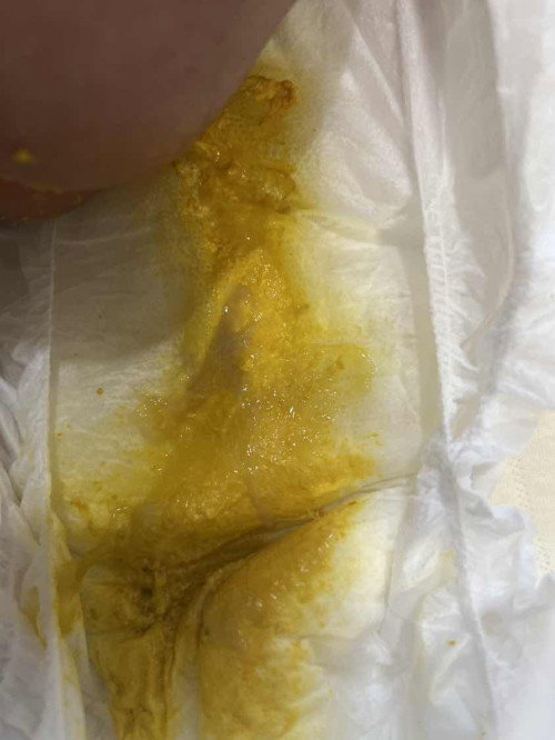 ลูก1เดือน10วัน แม่ลองเสริมนมให้
S26สีม่วง  เสริมได้2วัน นมผง+นมน้องอึแบบนี้
คือน้องไม่ถูกกับนมใช่มั้ยคะ ต้องพาน้องไปหาหมอไหม