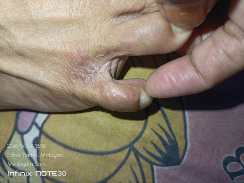 Ada x mommies kat sini pernah kena mcm ni? Terasa gatal sampai kadang² terasa panas..