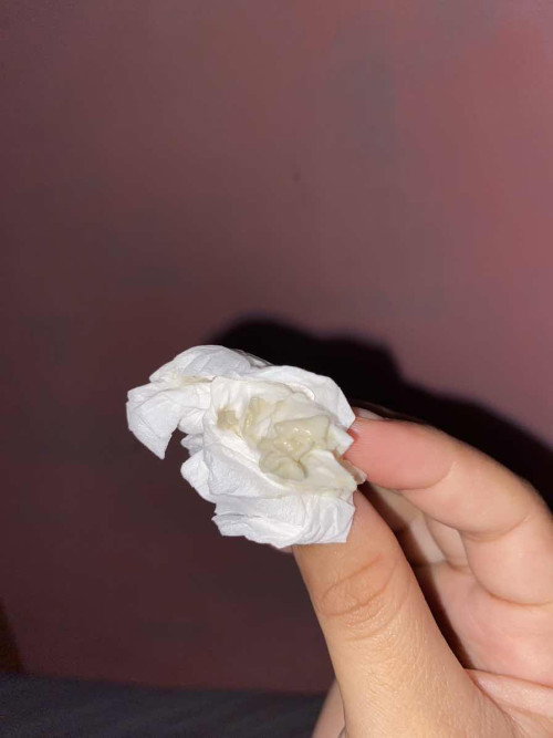 keputihan menggumpal normal atau tidak?