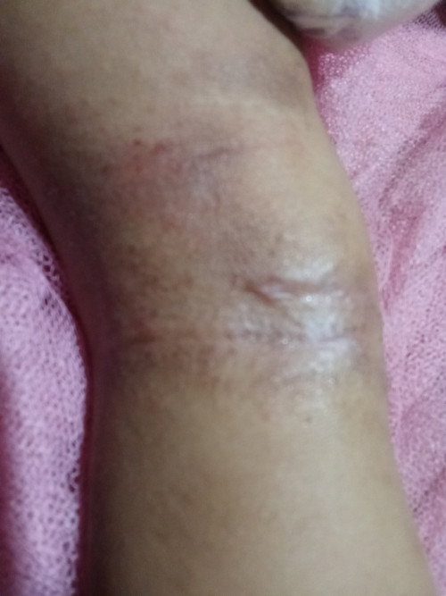 Kulit gatal dilipatan bayi