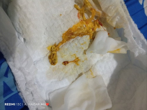 BAB berlendir dan ada darah