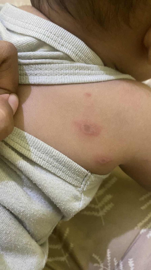 Merah merah pada bayi