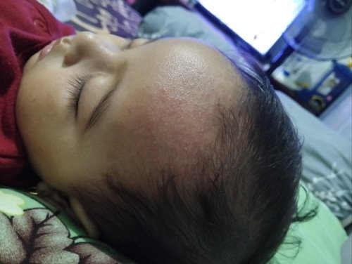 Bruntusan di jidat dan area dada dekat leher