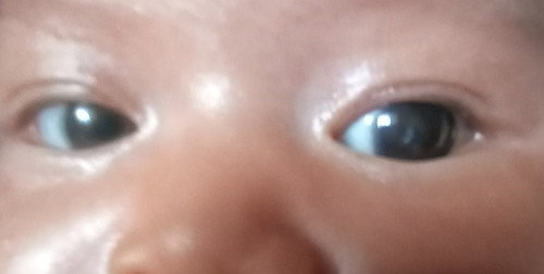 Retinoblastoma ( kanker mata ) bayi usia 2 bulan