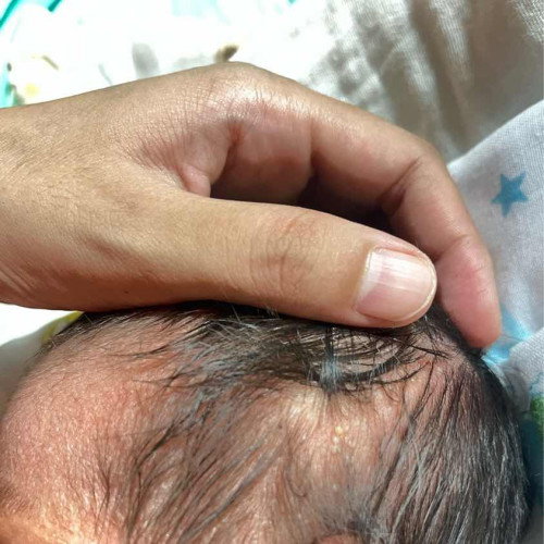 แรกเกิด ตุ่มบนหัว