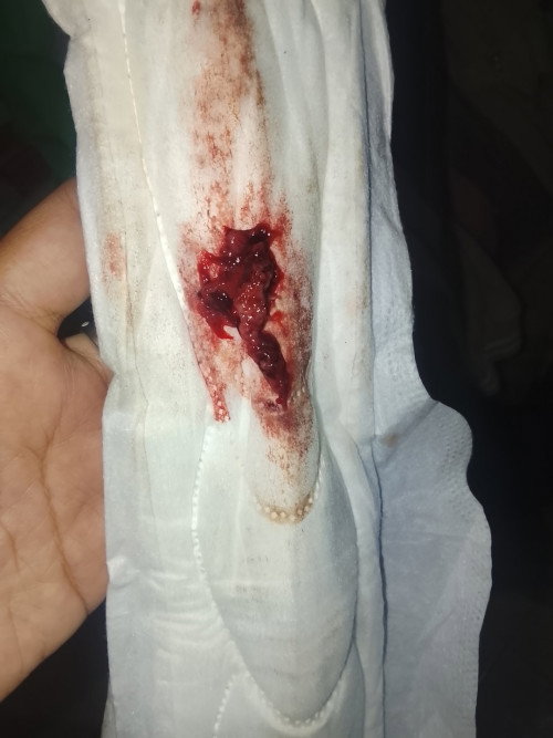 Ini keguguran apa gumpalan haid