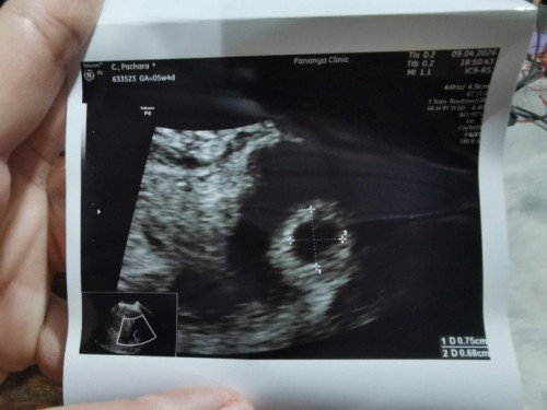 5สัปดาห์ มีเลือดออกในมดลูกไข่ไม่กลม มีใครเป็นบ้างคะ