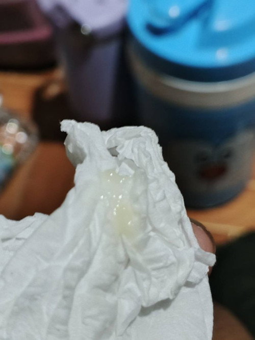 แบบนี้เป็นเชื้อราใช่ไหมค่ะ  รู้สึกว่าสีติดเขียว