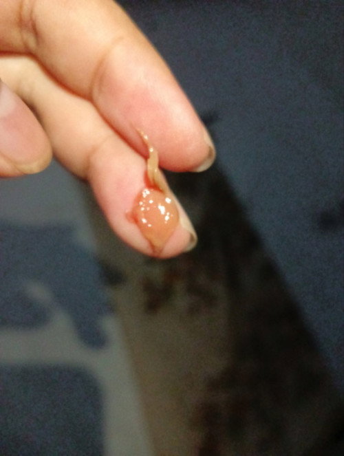 Pasca sc 50 hari keluar gumpalan kaya daging/selaput