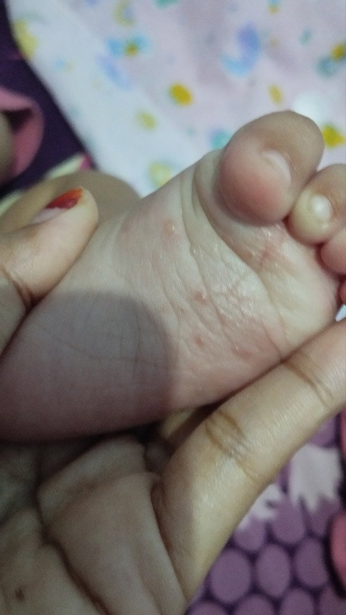 Ini kenapa dan gimana penyembuhannya, udah ke puskesmas cuma dikasih salep tapi kok belum sembuh