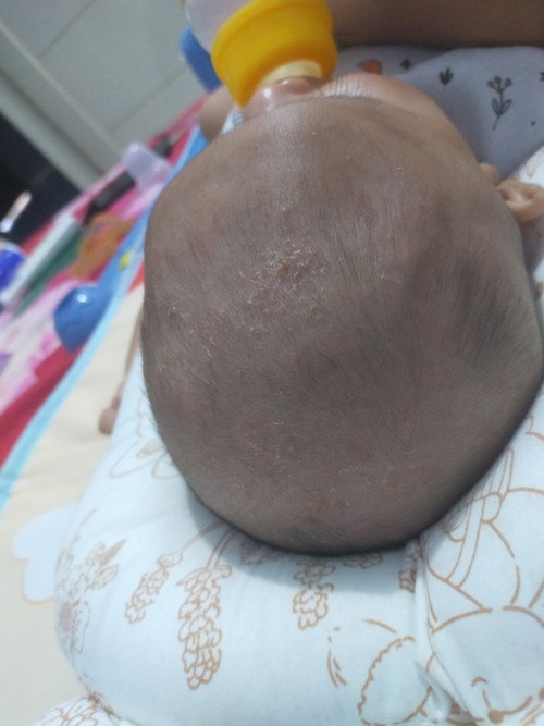 kepala bayi plontos