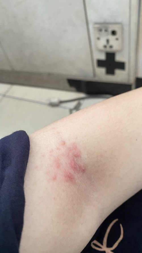 Muncul ruam tapi tidak gatal