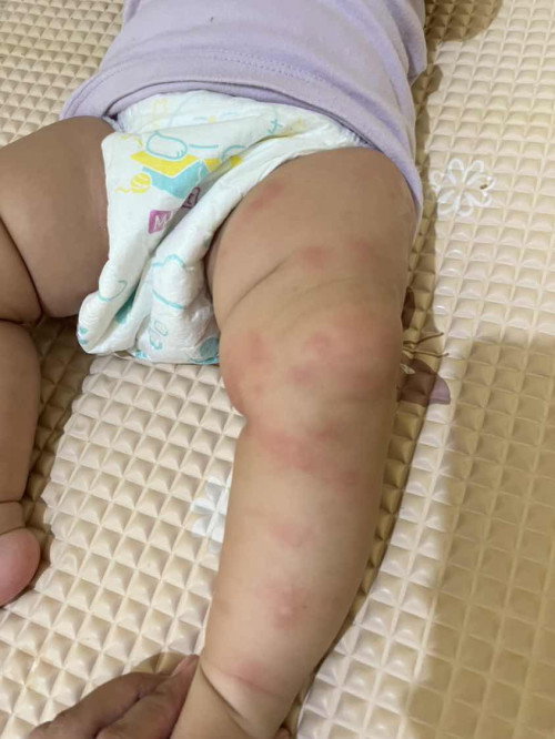 Badan bayi bintik merah