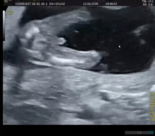 Konfirmasi JK baby di 15 weeks