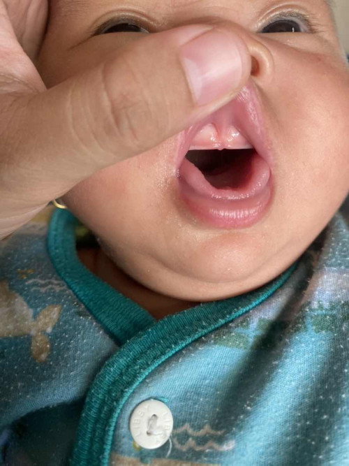 Apakah gusi bayi emang seperti ini atau ini termasuk liptie?