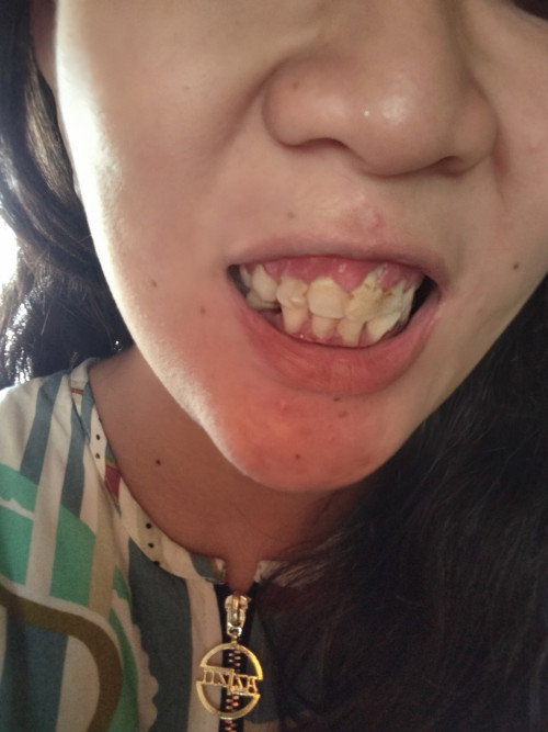 Minggu 26 hari 4 gusi meradang dan gigi goyang