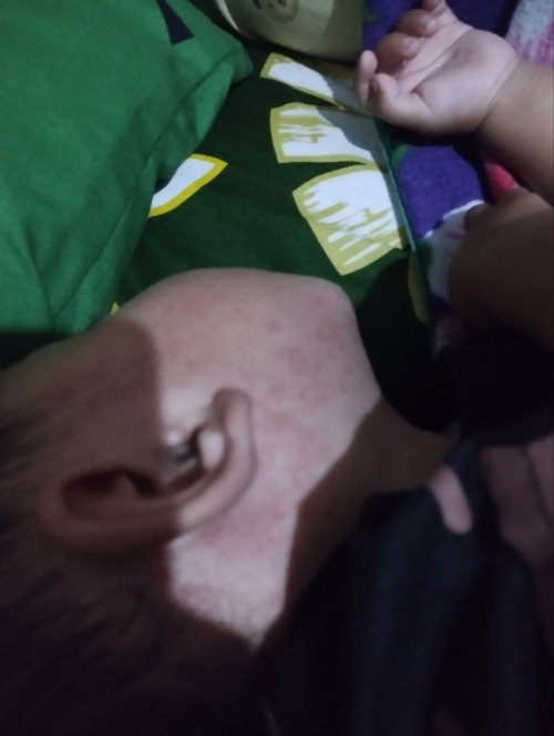 khawatir takut campak