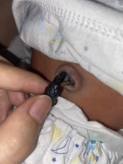 สะดือลูกเป็นแบบนี้ต้องไปหาหมอมั้ยคะ