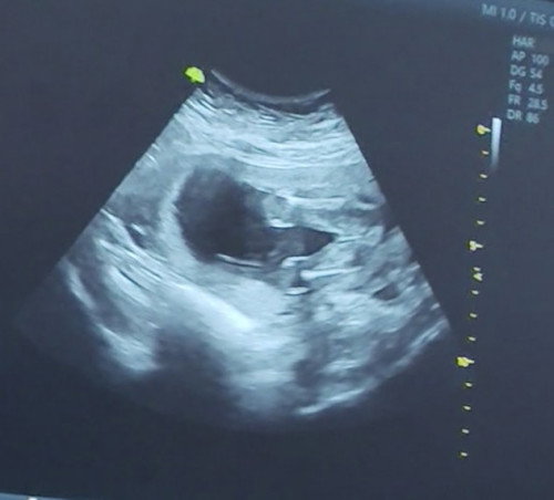 Gender at 19weeks