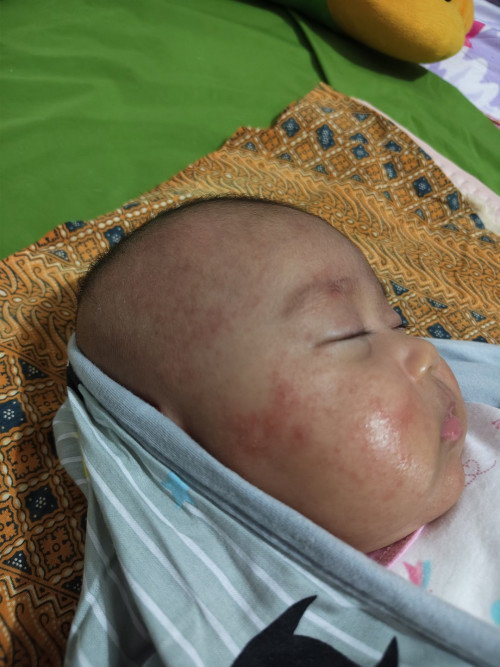 Ruam merah di pipi dan dada