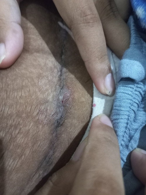 Bunda" bantu jawab dong,aku sc tgl 25 maret nah hari ini lukanya bolong,kira" obat nya apa ya bun?