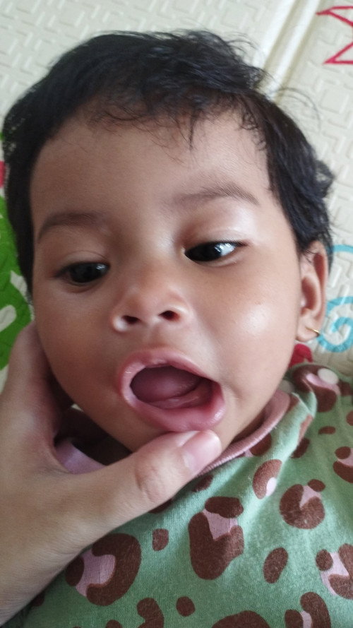 Gigi anak tumbuh miring