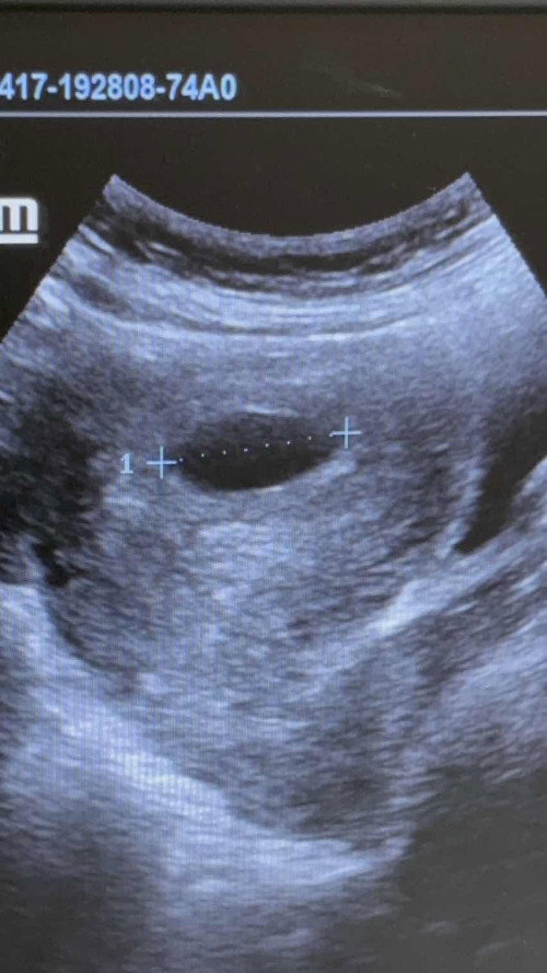 12 Weeks Scan Nampak Kantung Seja