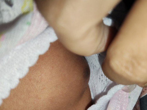 Benjolan di Payudara Bayi Perempuan