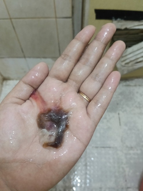 Keluar lendir coklat banyak dari kemarin usia kehamialn 38 minggu tapi tidak disertai kontraksi