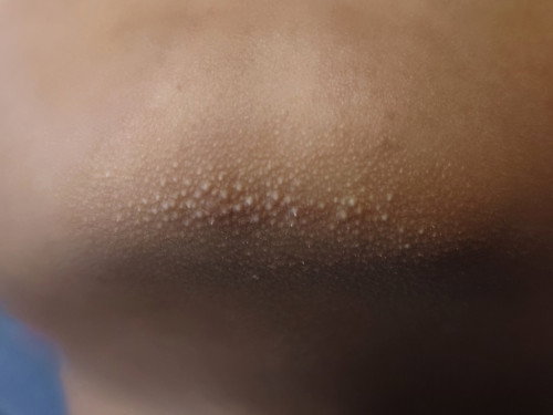 ใช่สิวข้าวสารหรือไม่