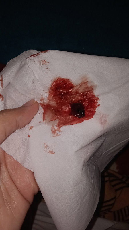 Sya hmil 9 Minggu wkt usg tggl 14 bln ini katanya msih kantong apakah tnda kegugrn