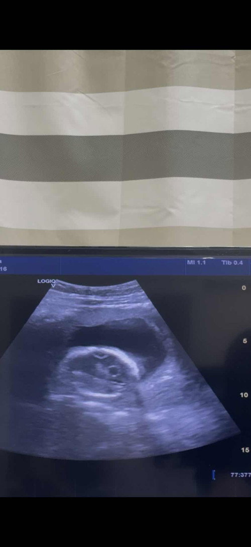 ซีสต์ในสมองของทารกในครรภ์