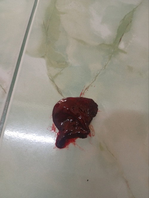 ภาวะแท้งคุกคาม