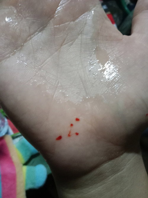 มีลิ่มเลือดขนาด (เวลาฉี่ ) มี อันตรายไม่คะ ไปหาคุณหมอเเล้ว หมอบอกไม่มีอะไร (ไม่มีอาการปวดท้องเลยค่ะ)